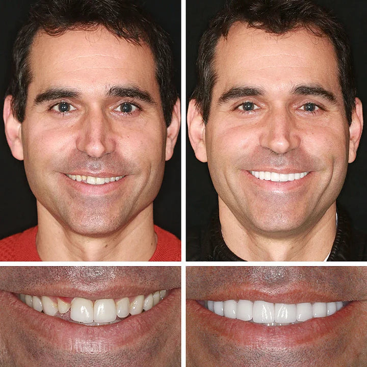 🌎Nur noch heute: 70 % Rabatt! ⏰Yagoo™ Medizinische Vollprothese mit starker Saugkraft🦷Erhalten Sie die Zertifizierung der American Dental Association (ADA).