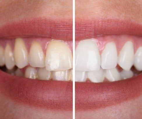 1+1 GRATIS | PureSmile® | Whitening Zahnpasta – Neutralisiert Gelbstich & sorgt für strahlende Zähne 😁