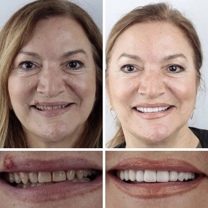 🌎Nur noch heute: 70 % Rabatt! ⏰Yagoo™ Medizinische Vollprothese mit starker Saugkraft🦷Erhalten Sie die Zertifizierung der American Dental Association (ADA).